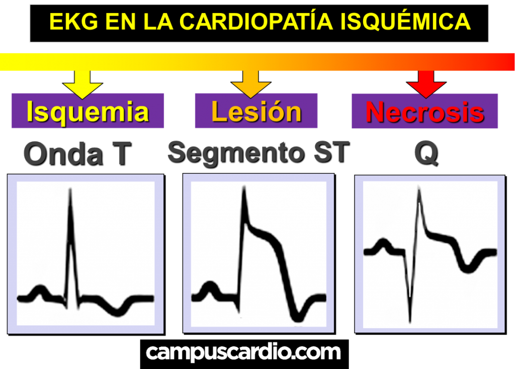 EKG en cardiopatia isquemica