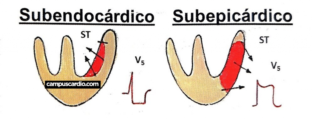 Subendocardico y Subepicardico