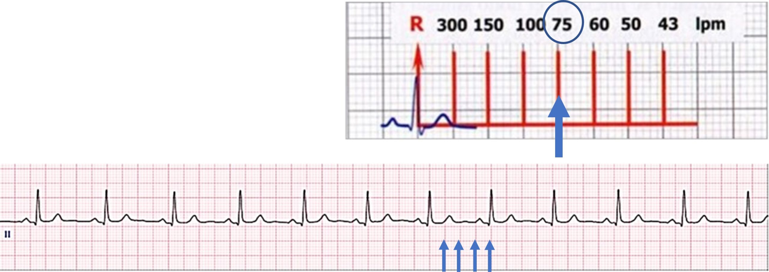  ARRITMIAS CARDÍACAS E INTERPRETACIÓN DE LA TELEMETRÍA PARA ENFERMERÍA