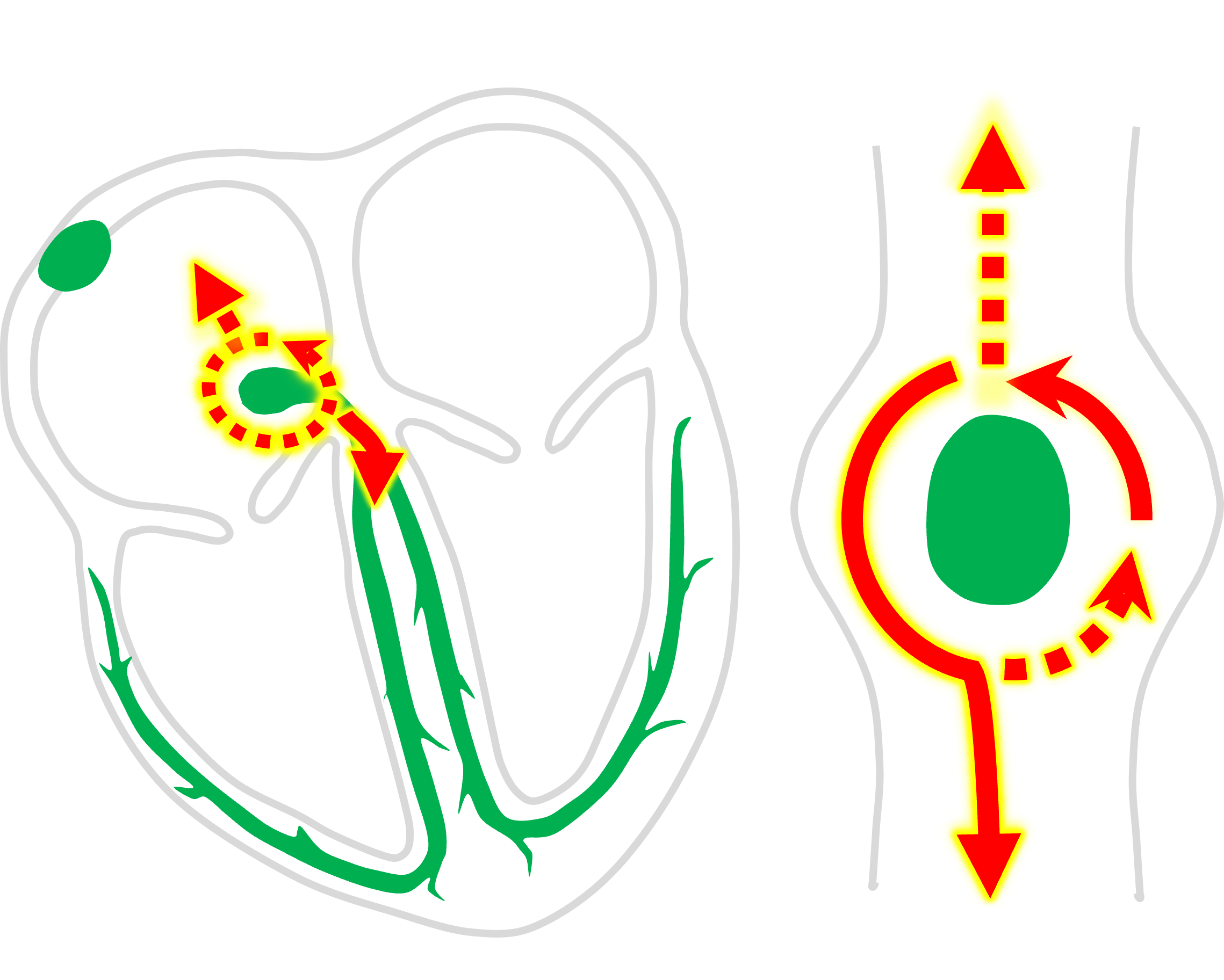  ARRITMIAS CARDÍACAS  Y TELEMETRÍAS PARA ENFERMERÍA – MICROPORT CRM